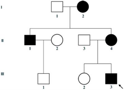 Clinical Manifestations of Alport Syndrome-Diffuse Leiomyomatosis Patients With Contiguous Gene Deletions in COL4A6 and COL4A5